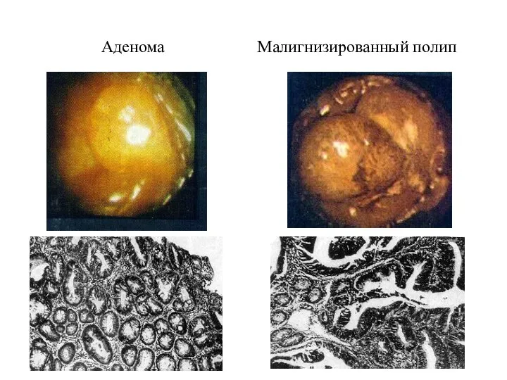 Аденома Малигнизированный полип