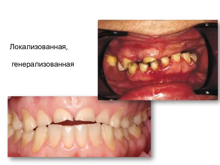 Локализованная, генерализованная