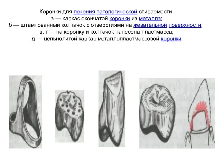 Коронки для лечения патологической стираемости а — каркас окончатой коронки из металла;