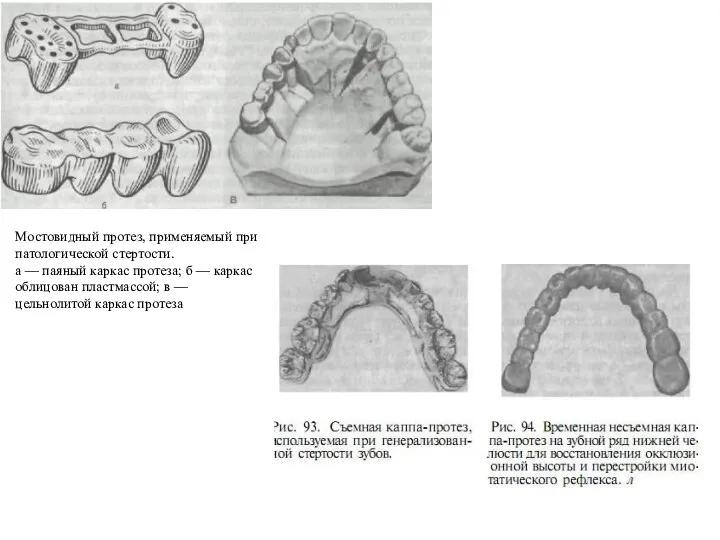 Мостовидный протез, применяемый при патологической стертости. а — паяный каркас протеза; б