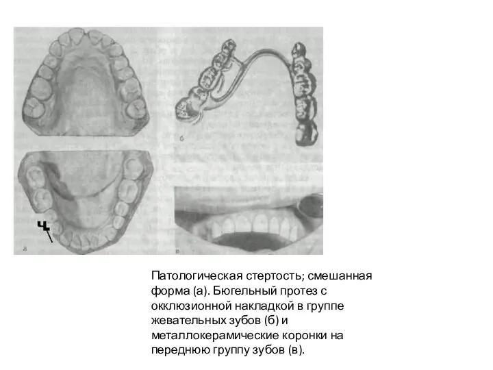 Патологическая стертость; смешанная форма (а). Бюгельный протез с окклюзионной накладкой в группе