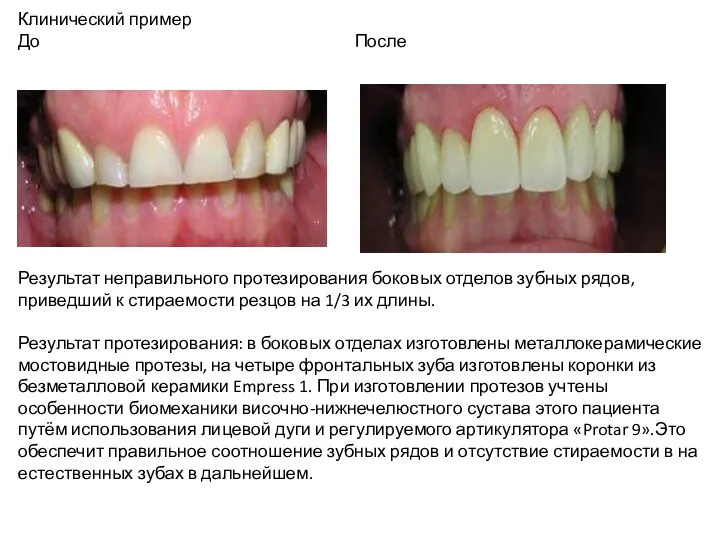 Клинический пример До После Результат неправильного протезирования боковых отделов зубных рядов, приведший