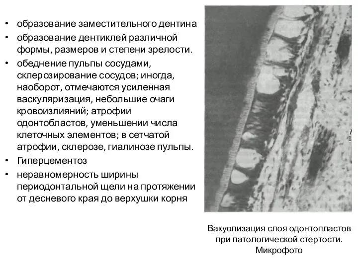образование заместительного дентина образование дентиклей различной формы, размеров и степени зрелости. обеднение