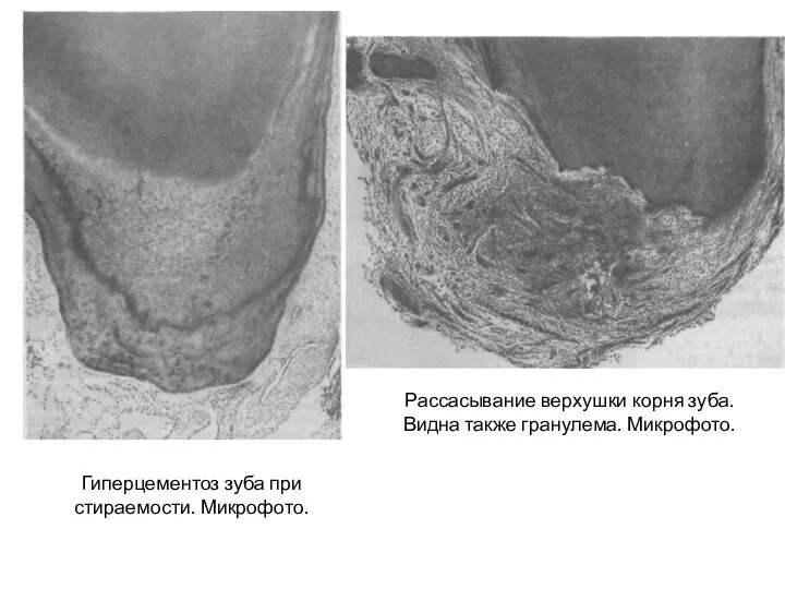 Рассасывание верхушки корня зуба. Видна также гранулема. Микрофото. Гиперцементоз зуба при стираемости. Микрофото.