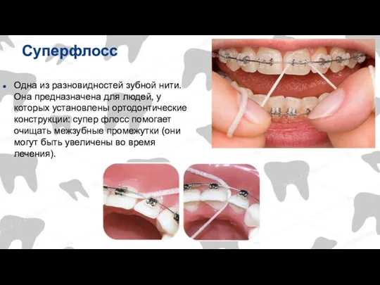 Суперфлосс Одна из разновидностей зубной нити. Она предназначена для людей, у которых