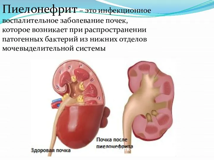 Пиелонефрит – это инфекционное воспалительное заболевание почек, которое возникает при распространении патогенных