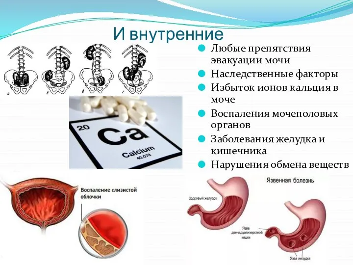 И внутренние Любые препятствия эвакуации мочи Наследственные факторы Избыток ионов кальция в