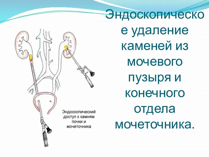 Эндоскопическое удаление каменей из мочевого пузыря и конечного отдела мочеточника.