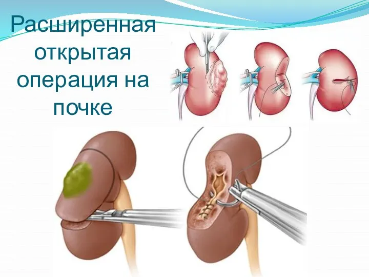 Расширенная открытая операция на почке