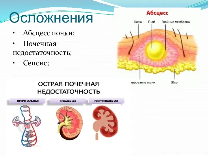 Осложнения • Абсцесс почки; • Почечная недостаточность; • Сепсис;