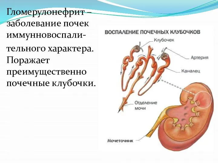 Гломерулонефрит – заболевание почек иммунновоспали- тельного характера. Поражает преимущественно почечные клубочки.