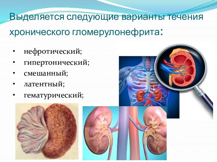 Выделяется следующие варианты течения хронического гломерулонефрита: • нефротический; • гипертонический; • смешанный; • латентный; • гематурический;