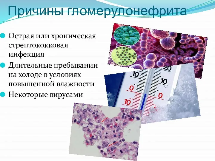 Причины гломерулонефрита Острая или хроническая стрептококковая инфекция Длительные пребывании на холоде в