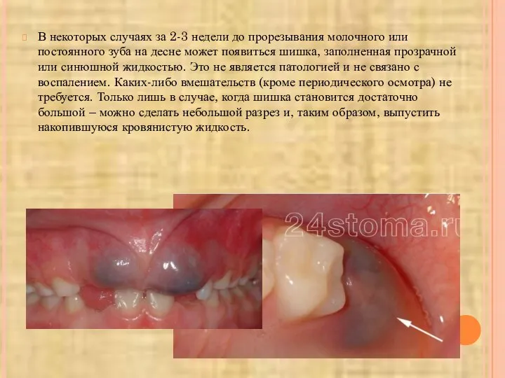 В некоторых случаях за 2-3 недели до прорезывания молочного или постоянного зуба