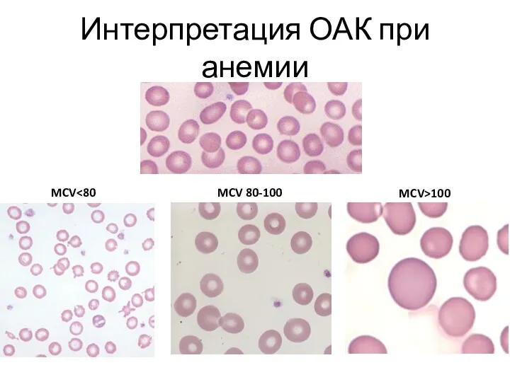 MCV MCV 80-100 MCV>100 Интерпретация ОАК при анемии