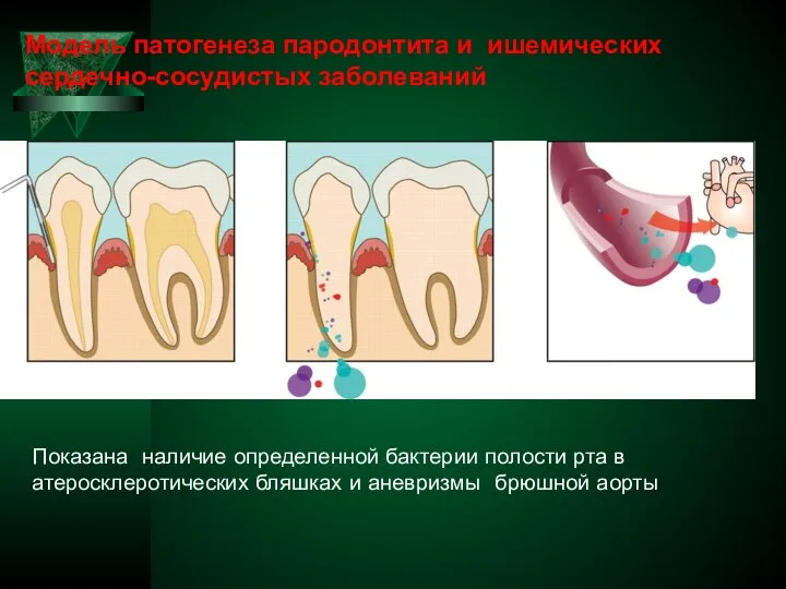 Модель патогенеза пародонтита и ишемических сердечно-сосудистых заболеваний Показана наличие определенной бактерии полости