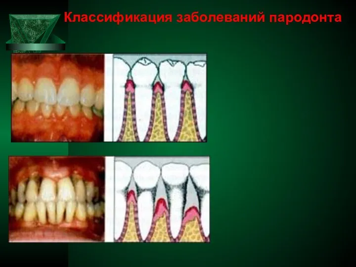 Классификация заболеваний пародонта