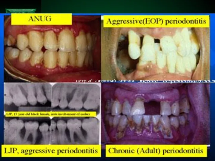 острый язвенный гингивит язвенно – некротического гингивита Венсана