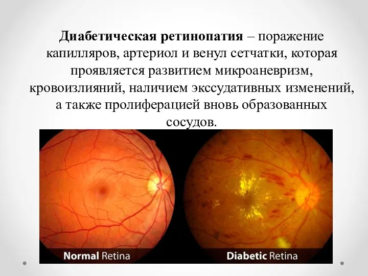 Диабетическая ретинопатия – поражение капилляров, артериол и венул сетчатки, которая проявляется развитием
