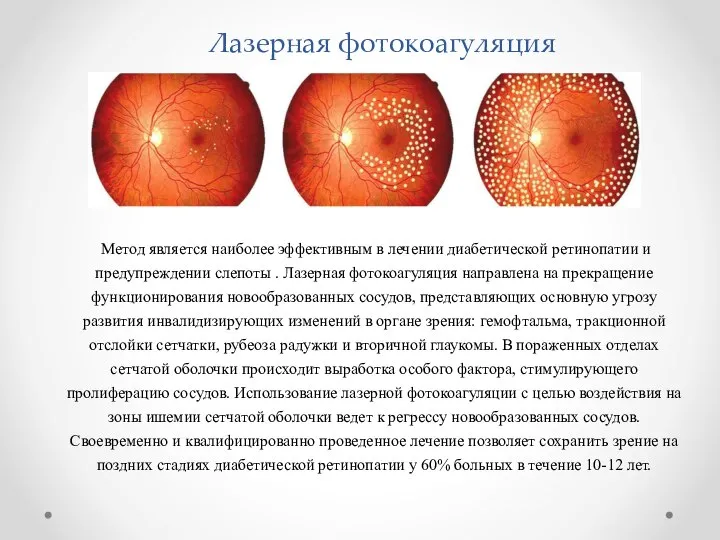 Лазерная фотокоагуляция Метод является наиболее эффективным в лечении диабетической ретинопатии и предупреждении