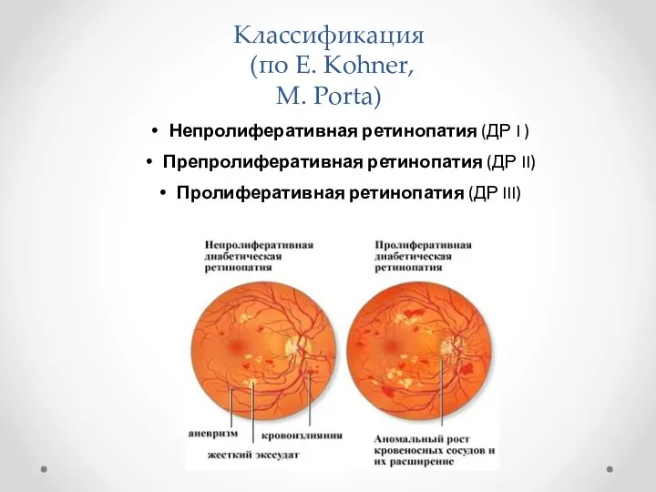 Классификация (по E. Kohner, M. Porta) Непролиферативная ретинопатия (ДР I ) Препролиферативная