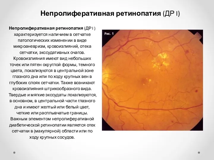 Непролиферативная ретинопатия (ДР I) Непролиферативная ретинопатия (ДР I ) характеризуется наличием в