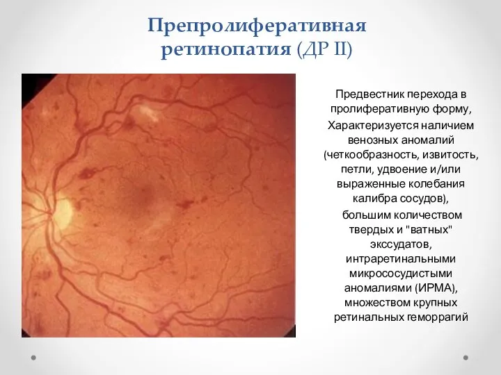 Препролиферативная ретинопатия (ДР II) Предвестник перехода в пролиферативную форму, Характеризуется наличием венозных