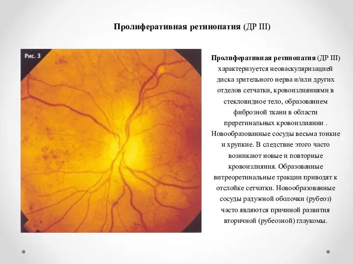 Пролиферативная ретинопатия (ДР III) Пролиферативная ретинопатия (ДР III) характеризуется неоваскуляризацией диска зрительного