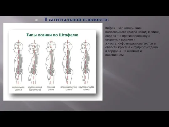 В сагиттальной плоскости: Кифоз – это отклонение позвоночного столба назад, к спине,