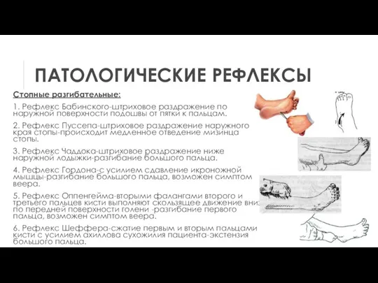 ПАТОЛОГИЧЕСКИЕ РЕФЛЕКСЫ Стопные разгибательные: 1. Рефлекс Бабинского-штриховое раздражение по наружной поверхности подошвы