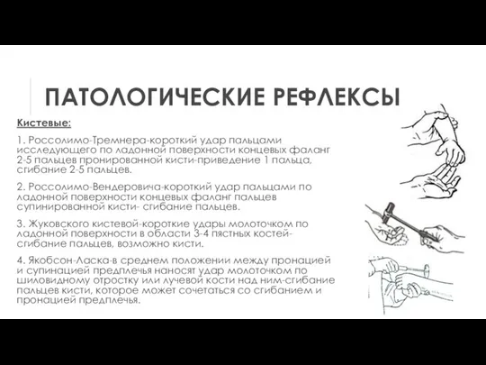 ПАТОЛОГИЧЕСКИЕ РЕФЛЕКСЫ Кистевые: 1. Россолимо-Тремнера-короткий удар пальцами исследующего по ладонной поверхности концевых