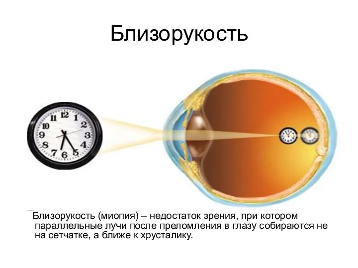 Близорукость Близорукость (миопия) – недостаток зрения, при котором параллельные лучи после преломления