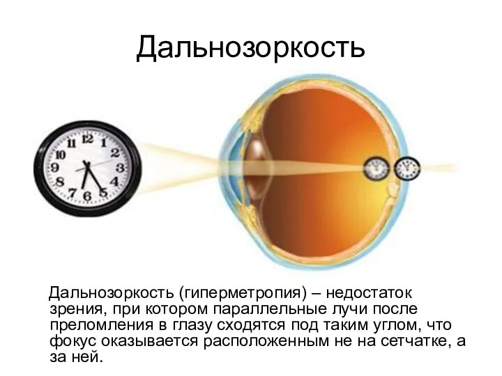 Дальнозоркость Дальнозоркость (гиперметропия) – недостаток зрения, при котором параллельные лучи после преломления