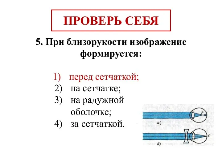 5. При близорукости изображение формируется: перед сетчаткой; на сетчатке; на радужной оболочке;