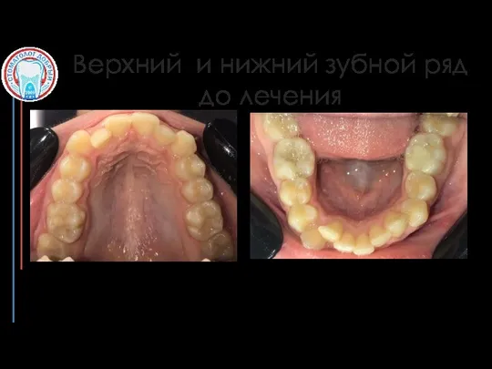 Верхний и нижний зубной ряд до лечения