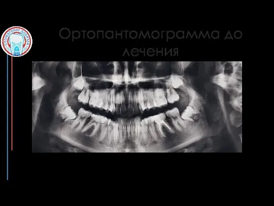 Ортопантомограмма до лечения Особенности: есть зачатки 8 зубов