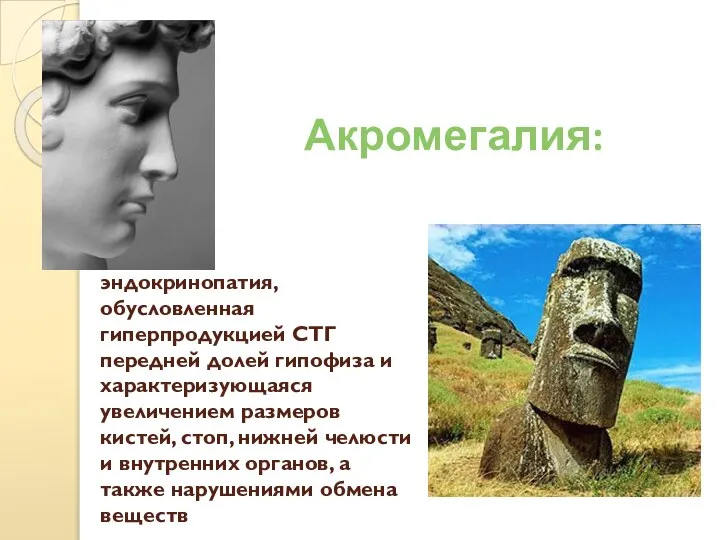 эндокринопатия, обусловленная гиперпродукцией СТГ передней долей гипофиза и характеризующаяся увеличением размеров кистей,