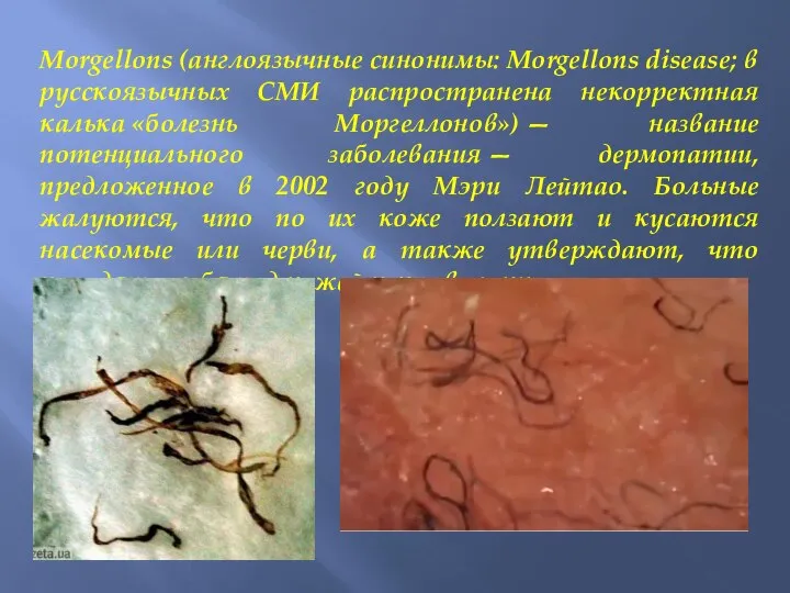 Morgellons (англоязычные синонимы: Morgellons disease; в русскоязычных СМИ распространена некорректная калька «болезнь
