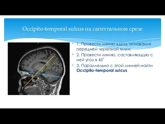 Occipito-temporal sulcus на сагиттальном срезе 1. Провести линию вдоль основания передней черепной