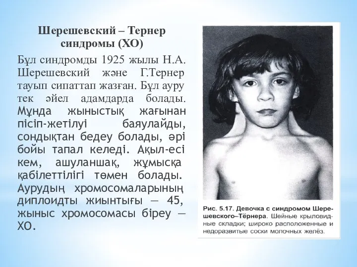 Шерешевский – Тернер синдромы (ХО) Бұл синдромды 1925 жылы Н.А.Шерешевский және Г.Тернер
