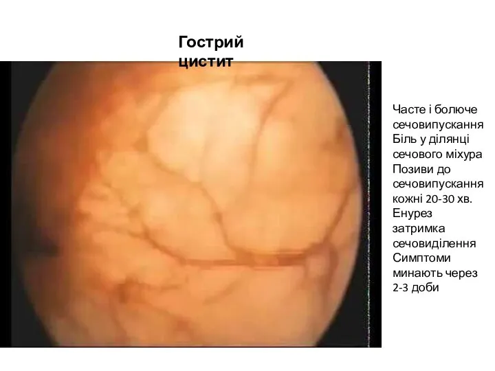 Часте і болюче сечовипускання Біль у ділянці сечового міхура Позиви до сечовипускання