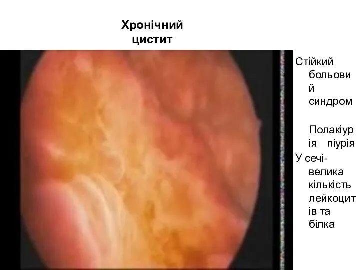 Стійкий больовий синдром Полакіурія піурія У сечі-велика кількість лейкоцитів та білка Хронічний цистит
