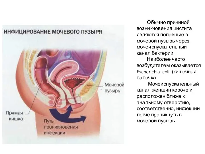 Обычно причиной возникновения цистита являются попавшие в мочевой пузырь через мочеиспускательный канал