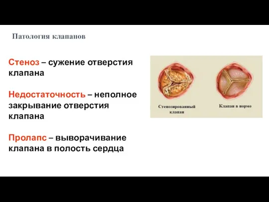 Стеноз – сужение отверстия клапана Недостаточность – неполное закрывание отверстия клапана Пролапс