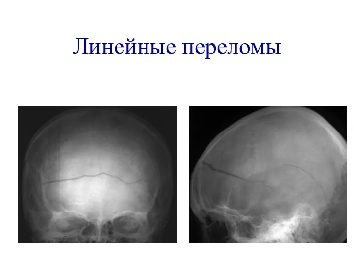 Линейные переломы