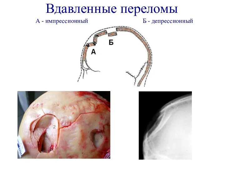 Вдавленные переломы А - импрессионный Б - депрессионный