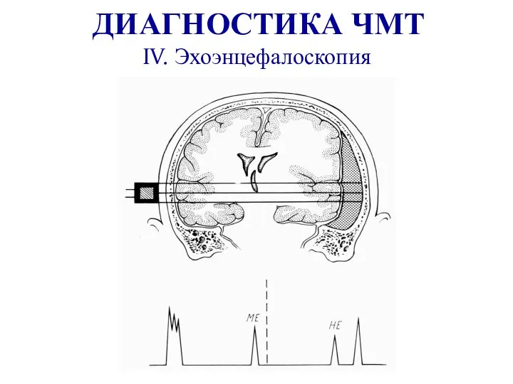 ДИАГНОСТИКА ЧМТ IV. Эхоэнцефалоскопия