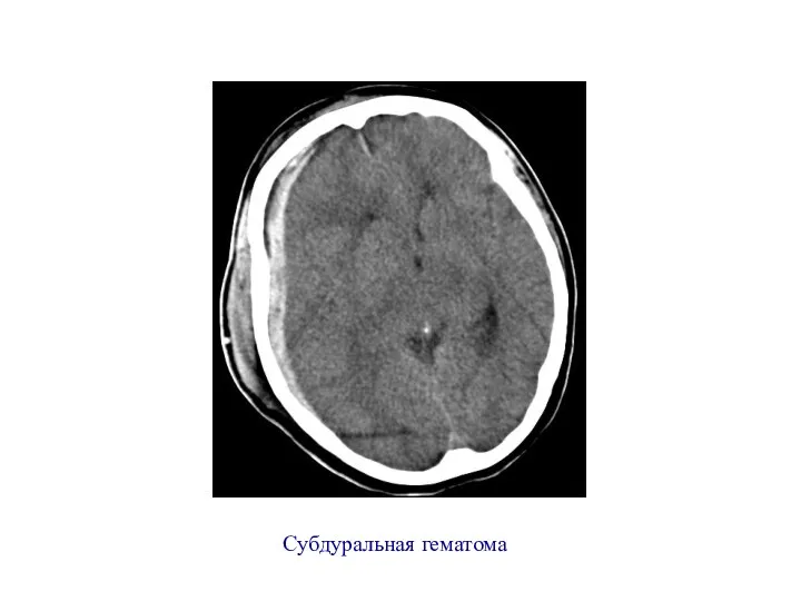 Субдуральная гематома
