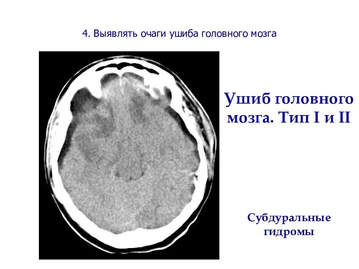 Ушиб головного мозга. Тип I и II Субдуральные гидромы 4. Выявлять очаги ушиба головного мозга