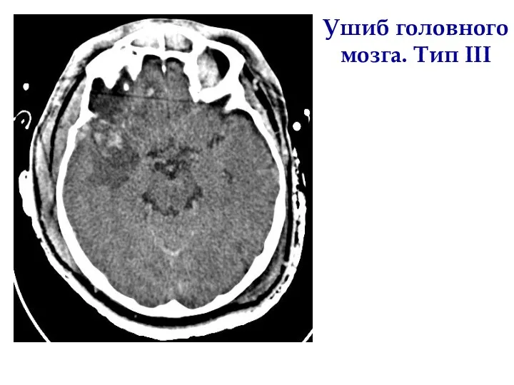 Ушиб головного мозга. Тип III